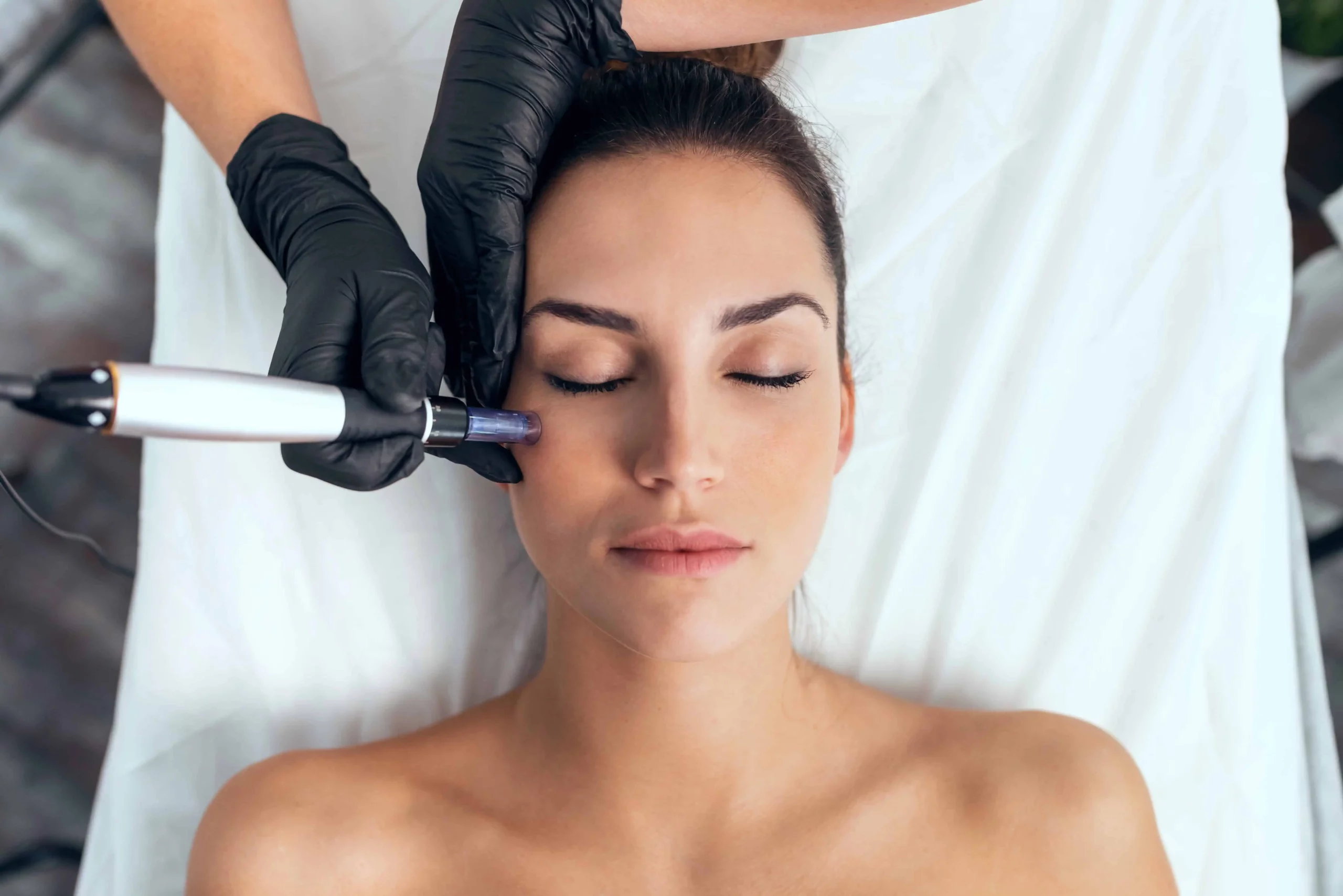 Microneedling Treatment in Coral Gables, FL - The Plump Room