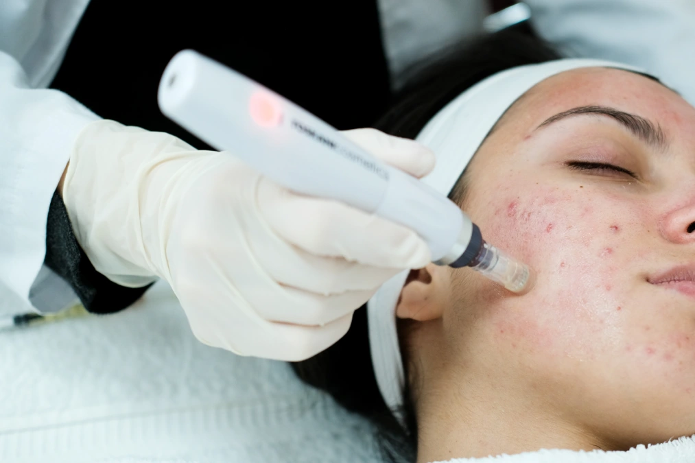 SkinPen Microneedling