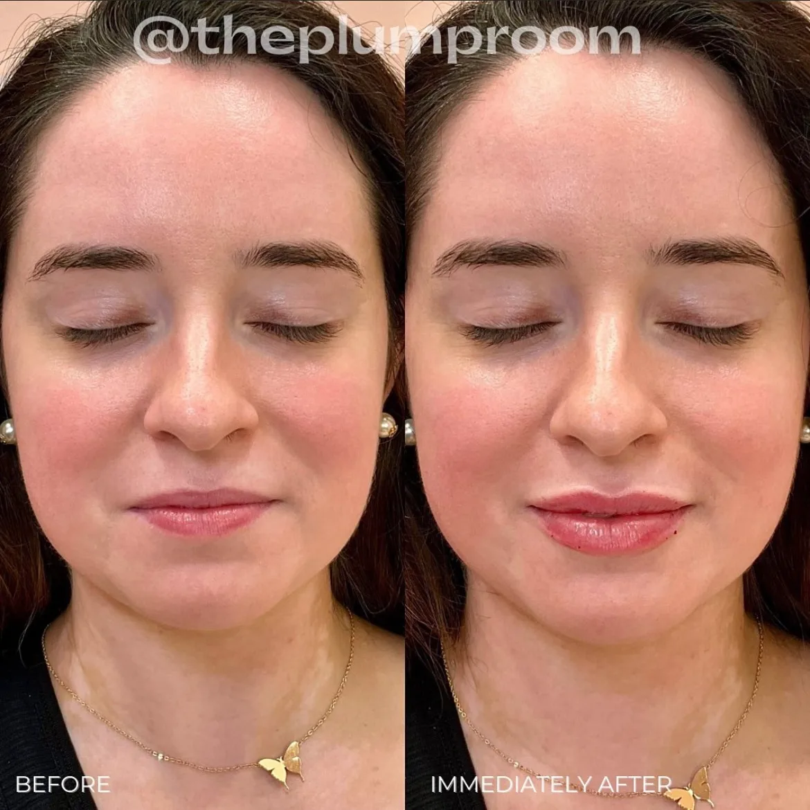 Dermal-Fillers-Before-After