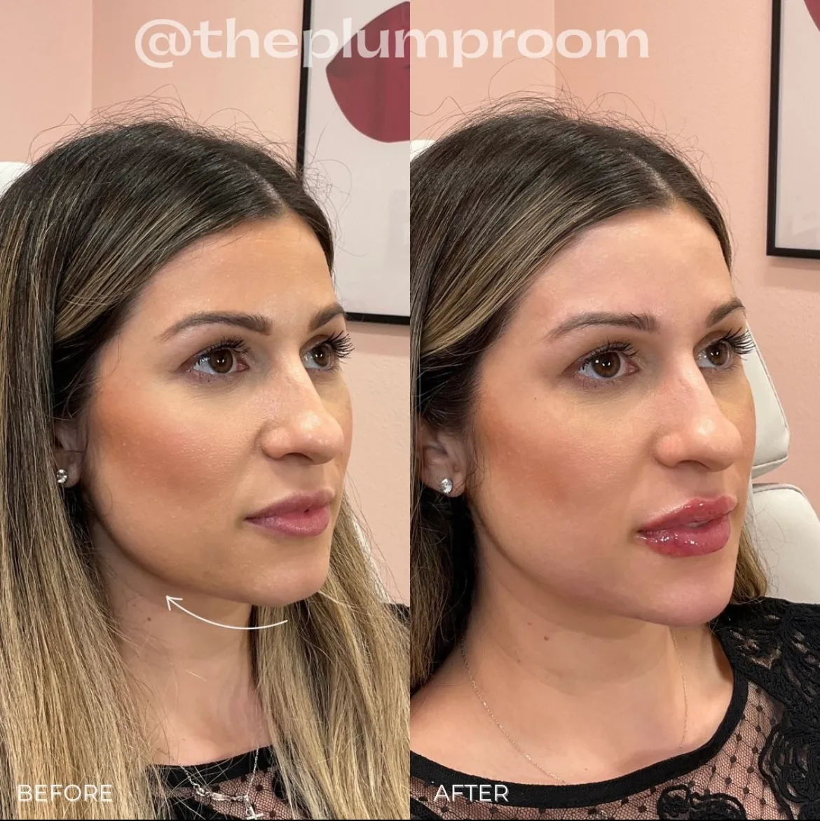 Dermal-Fillers-Before-After