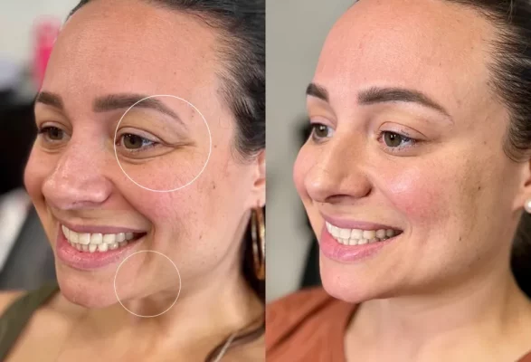 Wrinkle-Relaxers BEFORE & AFTER